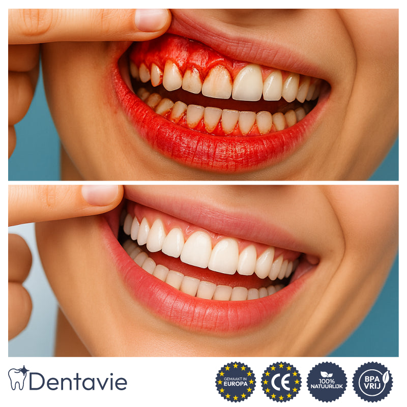 Dentavie tandvleesherstelgel |  Revitaliseert terugtrekkend tandvlees en maakt gele tanden in slechts 3 dagen